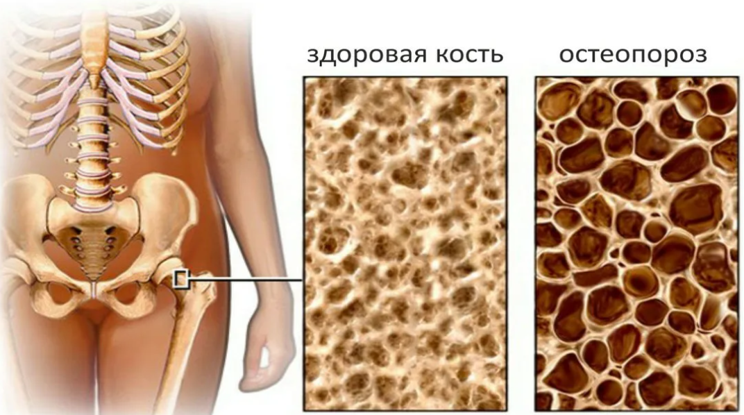 Черника — источник крепкой костной ткани и надежная профилактика остеопороза! Черника: укрепляем костную ткань и предотвращаем остеопороз!